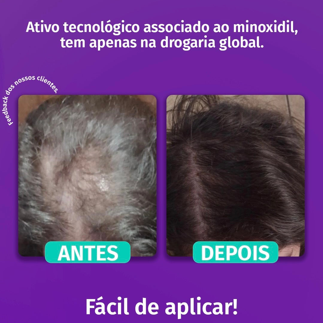 Minoxidil Turbinado – Tecnologia Avançada para um Crescimento Capilar Três Vezes Mais Rápido